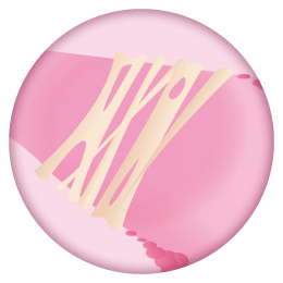 Verwachsungen in der Gebärmutter