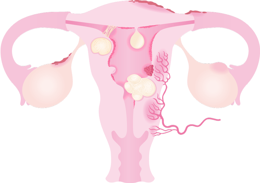 Base uterus